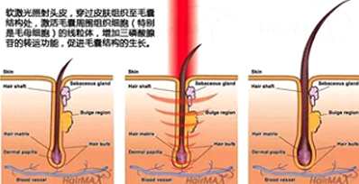 永久脫毛有哪些方式和對(duì)比效果